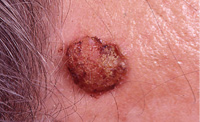 squamous cell cancer