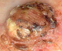 squamous cell cancer