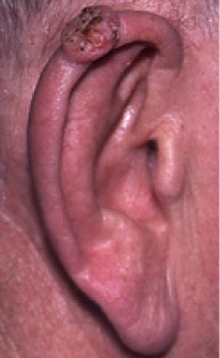 squamous cell cancer on ear