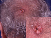 squamous cell cancer on scalp 